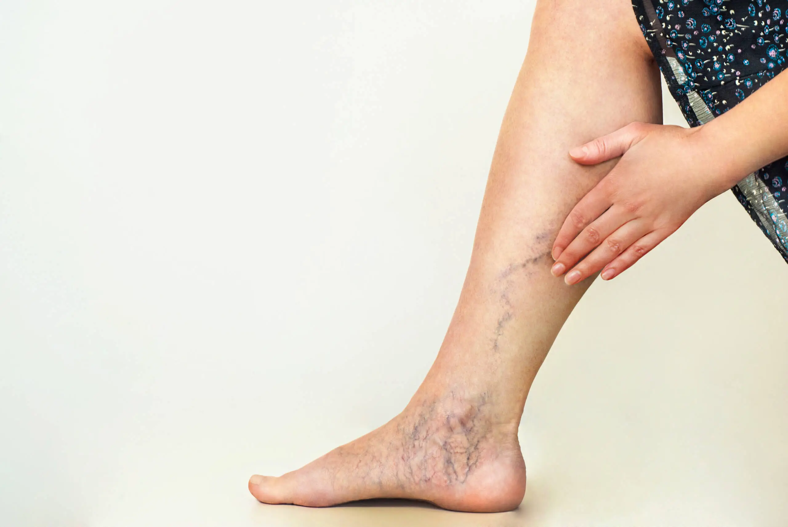 Varicose Veins ကို နှုတ်ဆက်လိုက်ပါ။