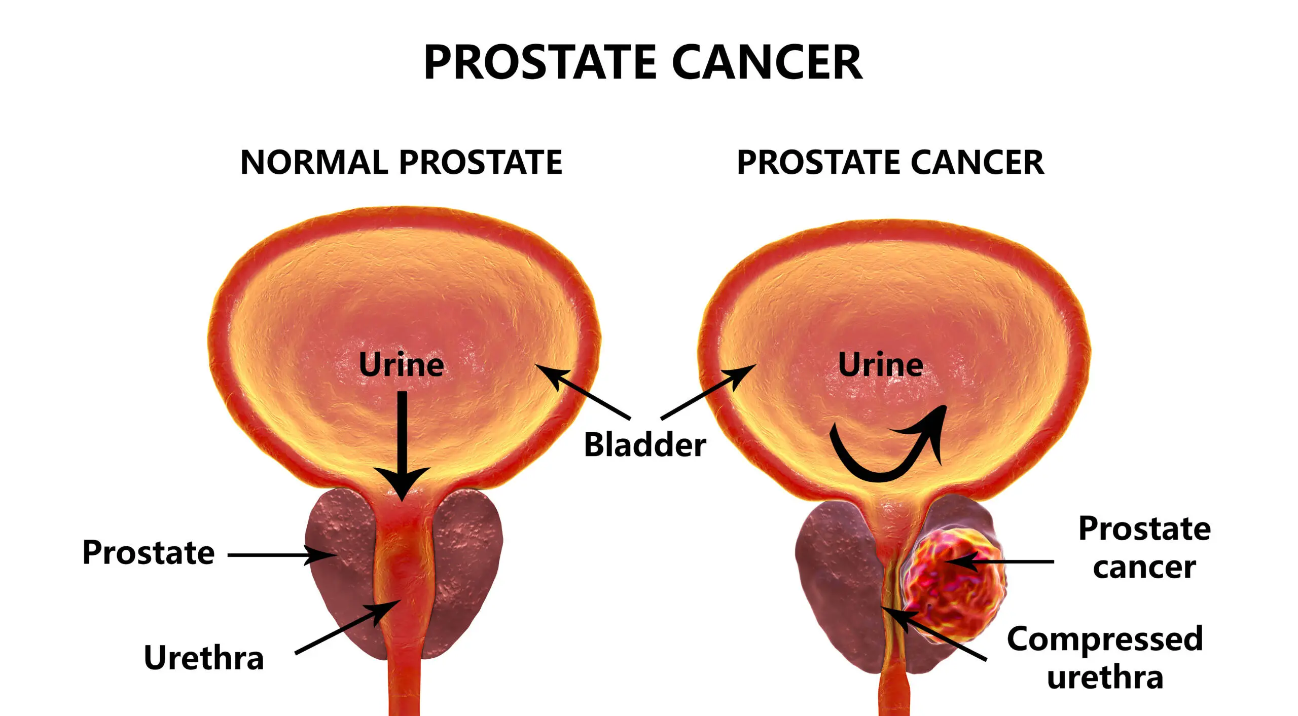 Lassen Sie uns gemeinsam den Prostatakrebs besiegen