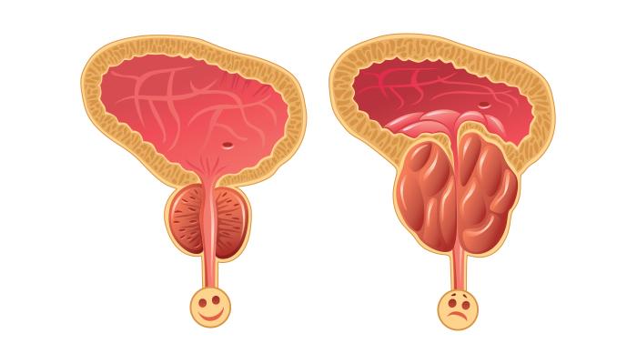 Ist Ihre Prostata vergrößert?