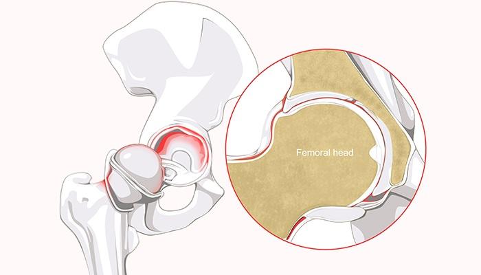 Labral Tear යනු කුමක්ද සහ එය සලකන්නේ කෙසේද?