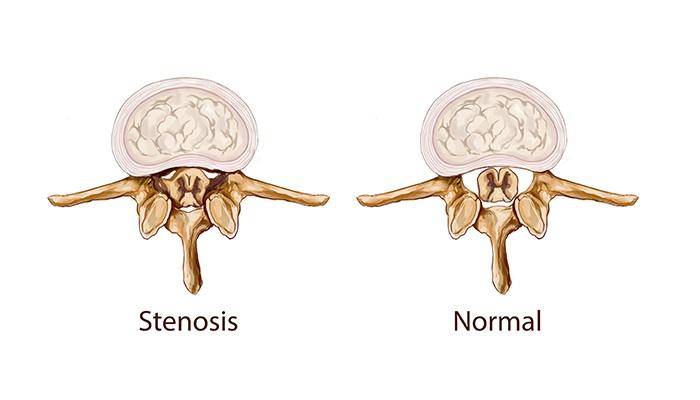 What Is Spinal Stenosis and How Is It Treated?