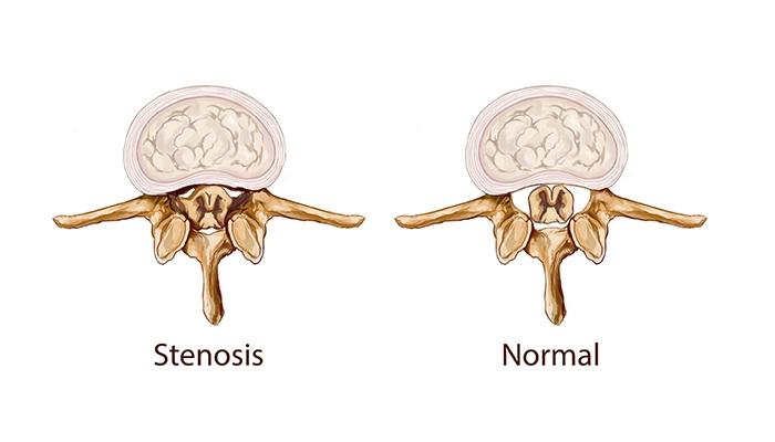 Spinal Stenosis ဆိုတာ ဘာလဲ ၊ ဘယ်လိုကုသပါသလဲ ။