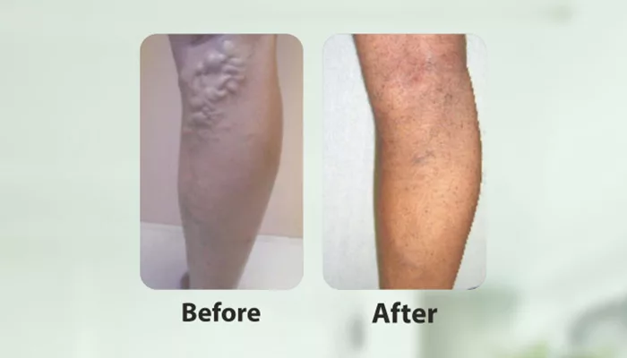 Varicose veins and glueing technology