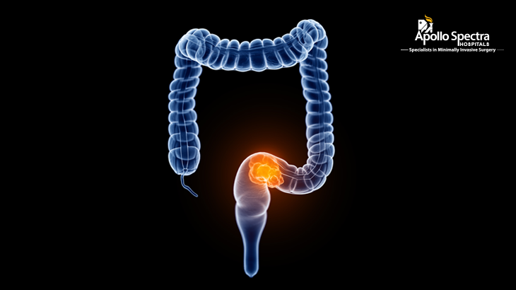 Colorectal سرجري- چار شيون جيڪي توھان کي ڄاڻڻ جي ضرورت آھي