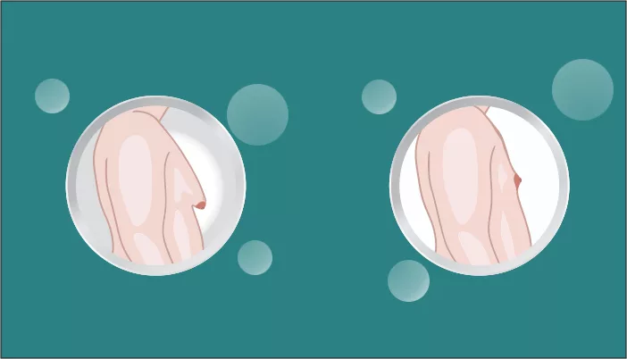 Gynecomastia-Male Breast Surgery
