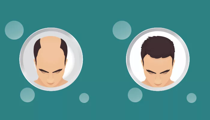 Know the Science behind Hair Transplant