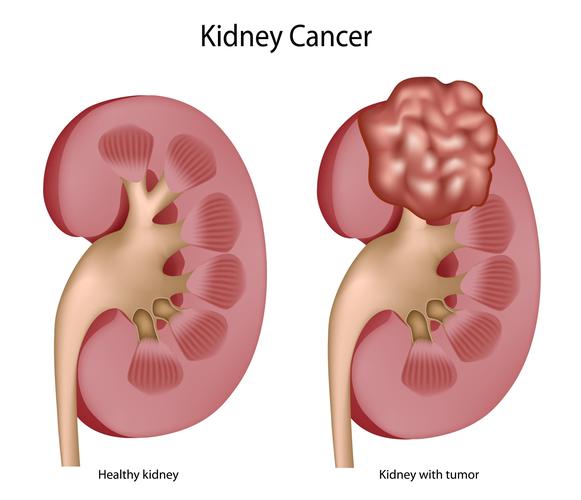 Kidney Cancer- Symptoms, Diagnosis and Treatment