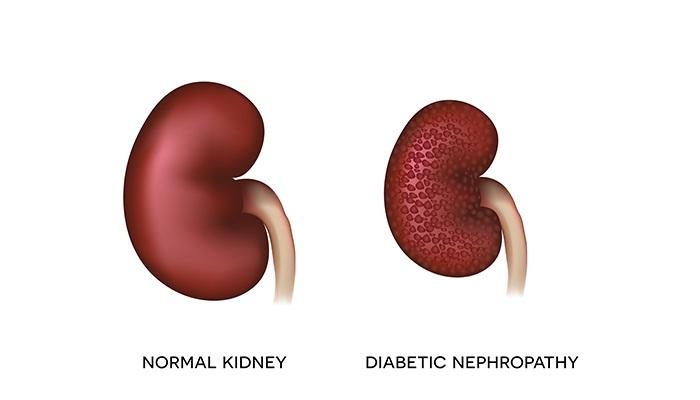 Diabetes and Urology: How Are They Related?