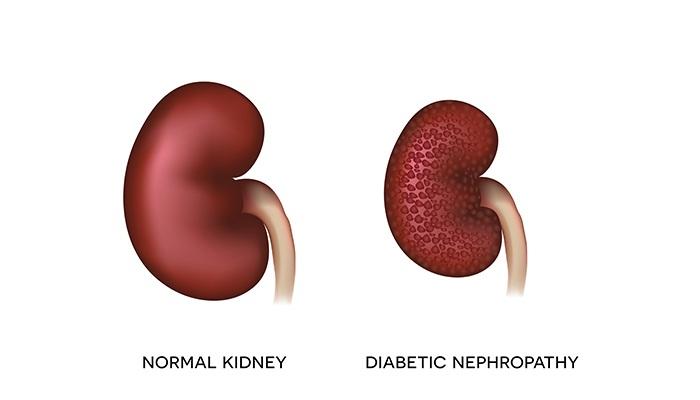 Diabetes dan Urologi: Apa Hubungannya?