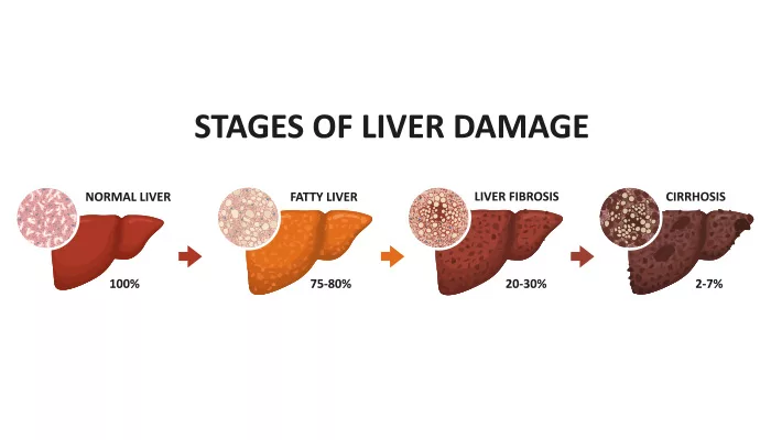 Fatty Liver: a growing disease