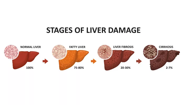 ફેટી લિવર: વધતી જતી બીમારી