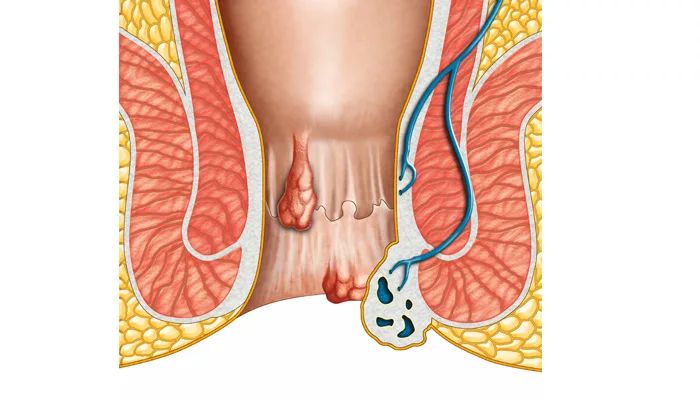 Différence entre fissure et fistule ?