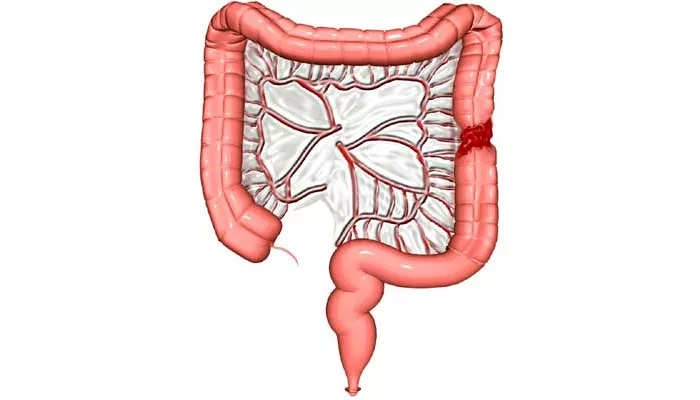 Partial Colectomy မှ မျှော်လင့်ရမည့်အရာ