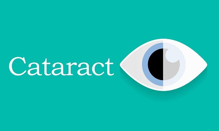 Cataract