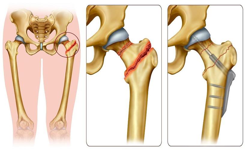 Mengelola vs Mengobati Fraktur Leher Femoral: Apa Pilihan Terbaik Anda?