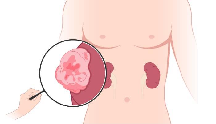 Pyeloplasty
