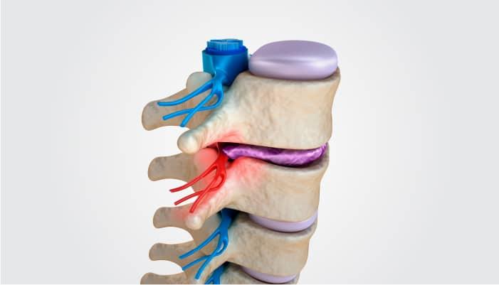 Verursacht ein Bandscheibenvorfall Rückenschmerzen?