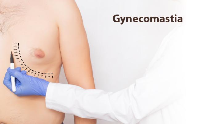 Gynecomastia පිළිබඳ මිථ්‍යාවන් ඉවත් කිරීම