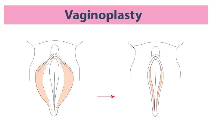 À faire et à ne pas faire après une vaginoplastie