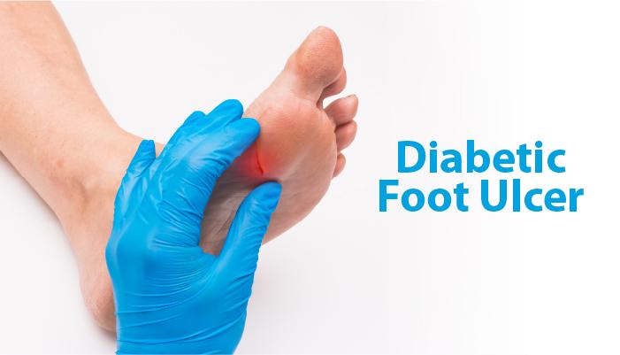 علامات جو آپ کو ذیابیطس کے پاؤں میں السر ہوسکتے ہیں۔