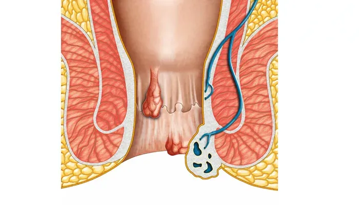 శస్త్రచికిత్స లేకుండా పైల్స్ చిక఍఍వచవి কি?