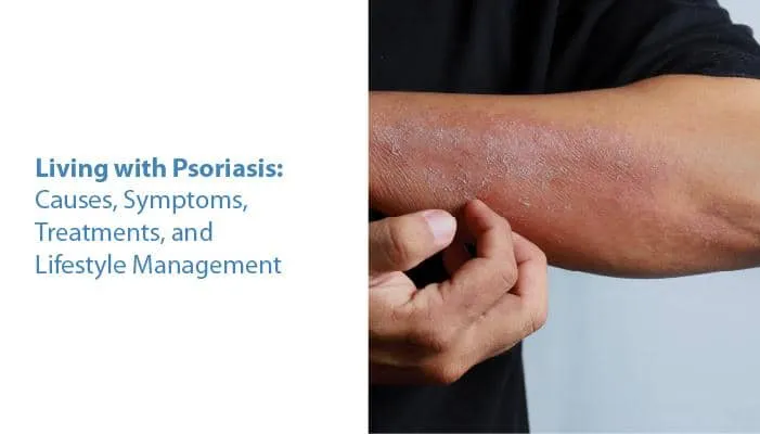 Psoriasis संग बाँच्न: कारण, लक्षण, उपचार, र जीवनशैली व्यवस्थापन
