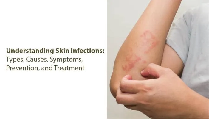 त्वचा संक्रमण को समझना: प्रकार, कारण, लक्षण, रोकथाम और उपचार