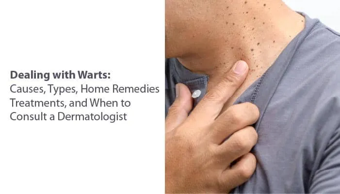 Dealing with Warts: Causes, Types, Home Remedies, Treatments, and When to Consult a Dermatologist