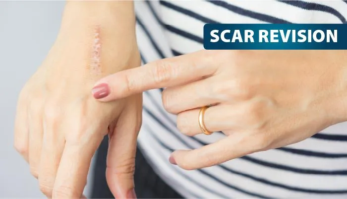 Scar Revision