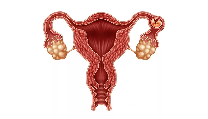 Endometriosis ဆိုတာ ဘာလဲ၊ သူ့ရဲ့ အဓိက ရောဂါလက္ခဏာတွေနဲ့ အကြောင်းရင်းတွေ