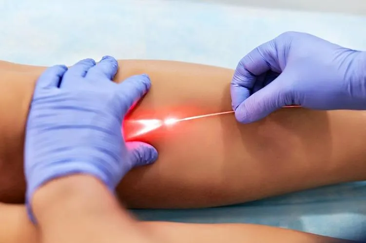 Laser treatment for varicose veins using focused light