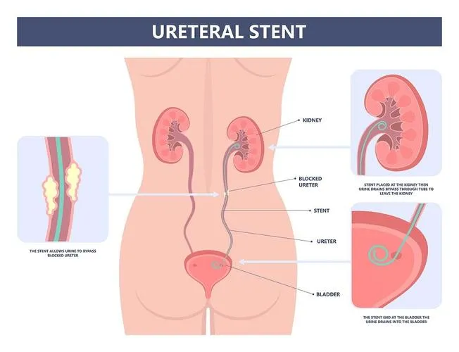 尿管ステント留置術とは何ですか? 手順と回復