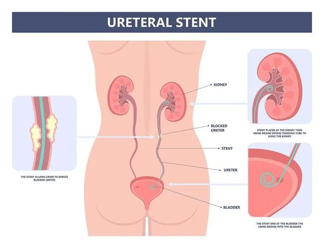 यूरेटरल स्टेंटिंग म्हणजे काय? प्रक्रिया आणि पुनर्प्राप्ती