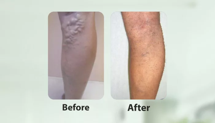 Varicose veins ۽ glueing ٽيڪنالاجي