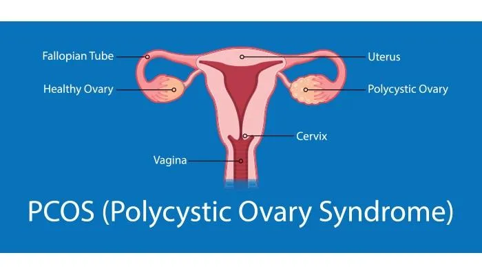 Polycystic ovary syndrome (PCOS) - लक्षण र कारणहरू