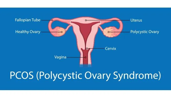 متلازمة المبيض المتعدد الكيسات (PCOS) - الأعراض والأسباب