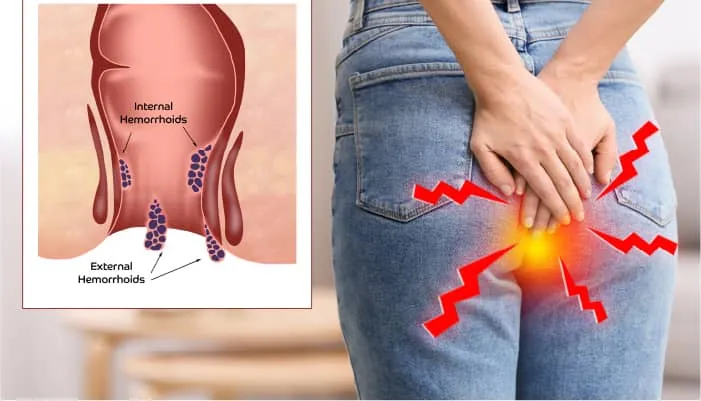 أكوام: الأسباب والجراحة