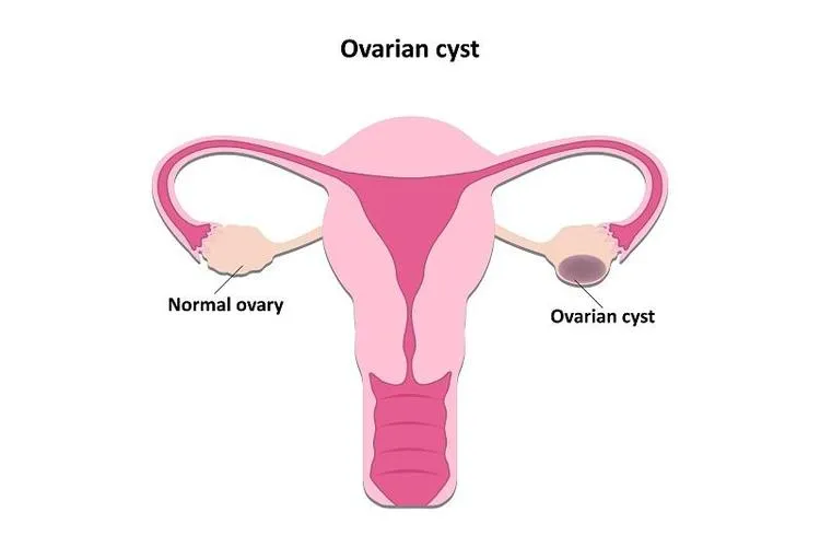 ڇا هڪ Ovarian Cyst عام ٿي سگهي ٿو