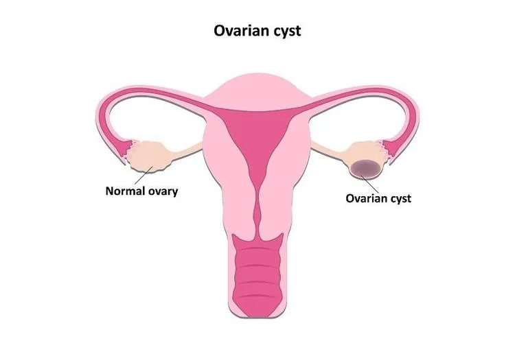क्या ओवेरियन सिस्ट सामान्य हो सकता है?