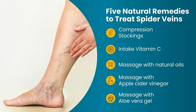 Can spider veins be treated naturally?