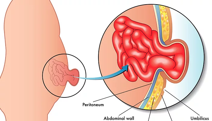 Apakah ada risiko yang terkait dengan Operasi Hernia?