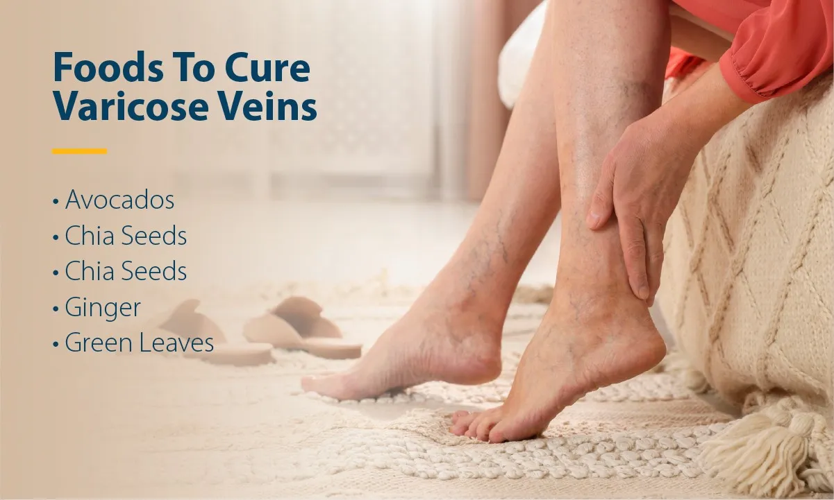 Foods To Cure Varicose Veins