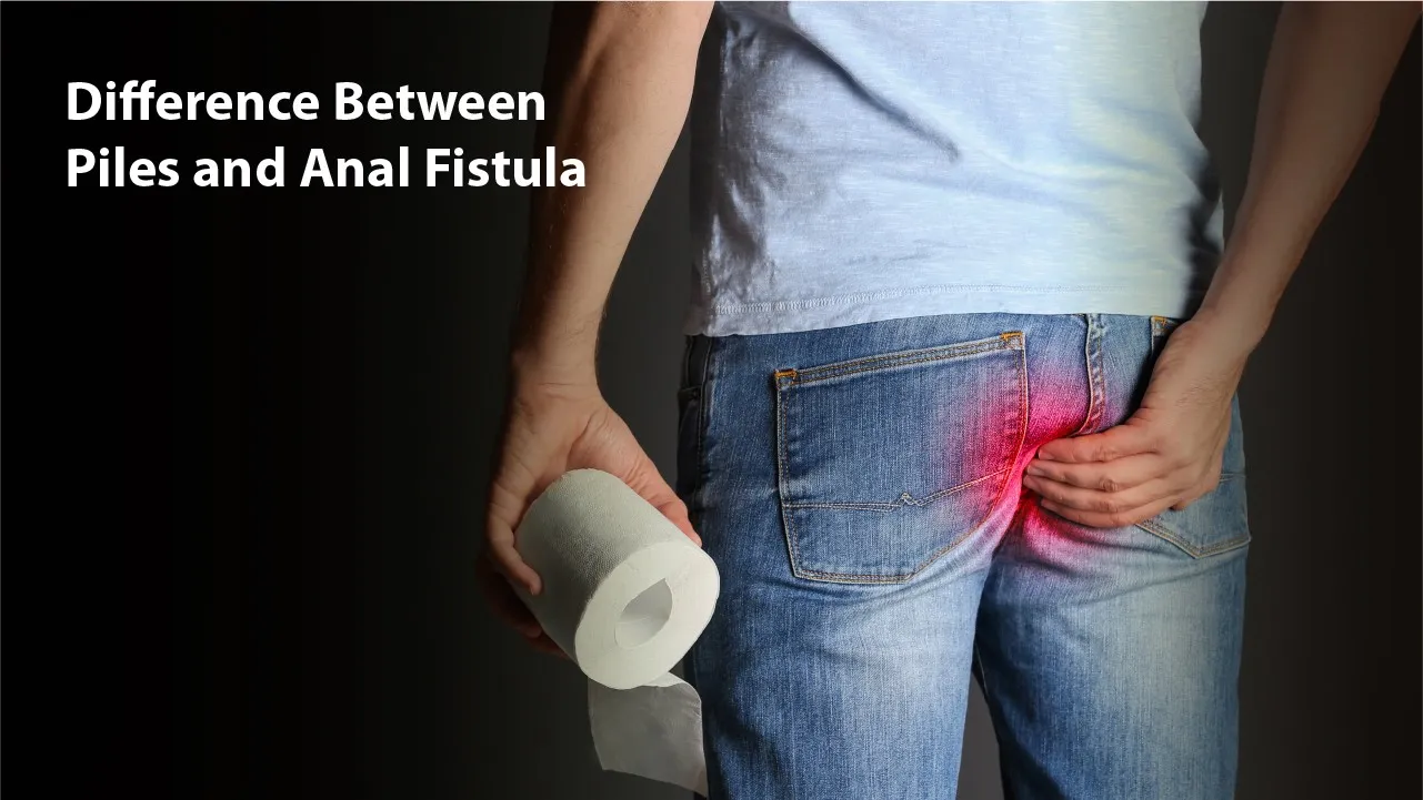 Difference Between Piles and Anal Fistula