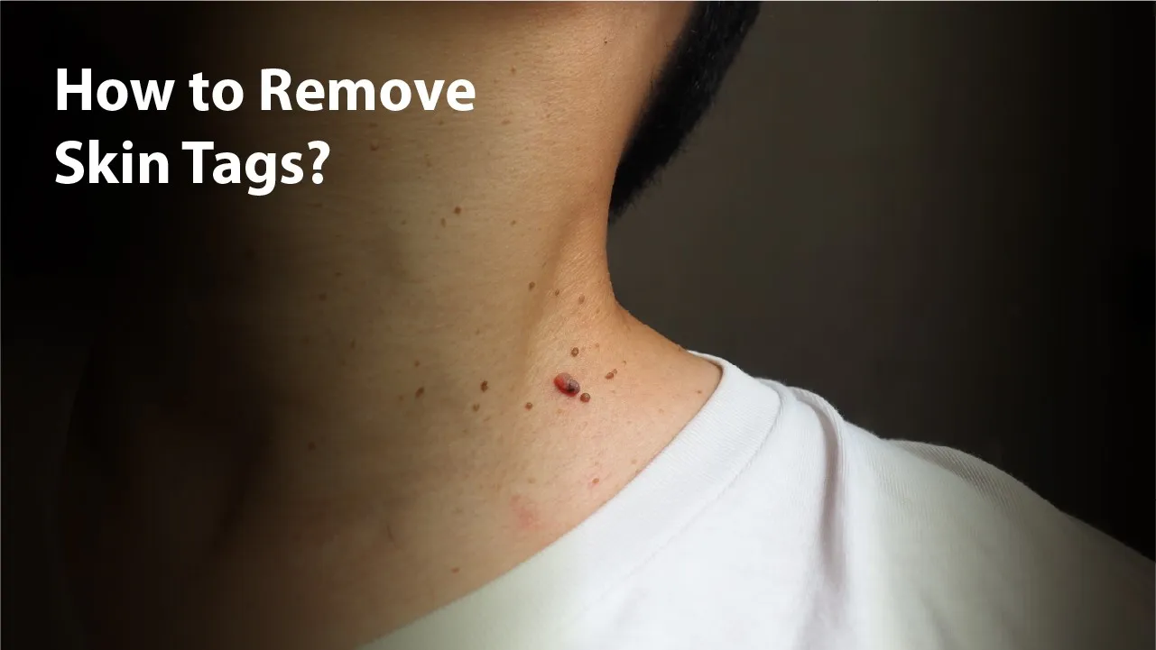 How to Remove Skin Tags