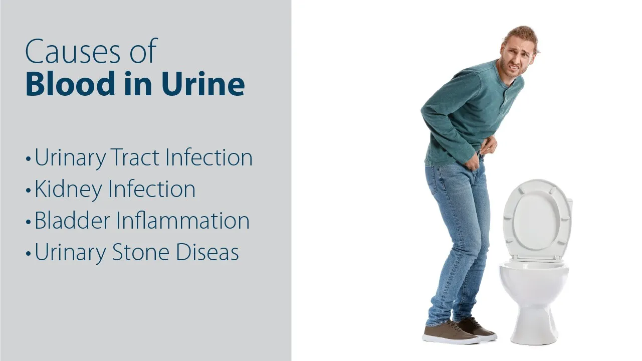 What Causes Blood in Urine?