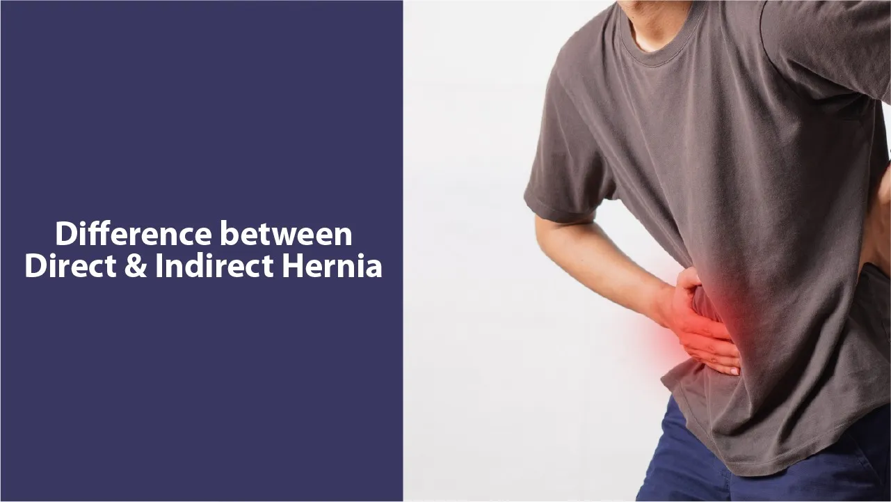 Difference Between Direct and Indirect Hernia
