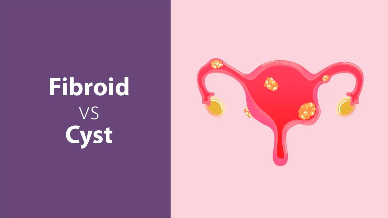 Fibroid vs Cyst