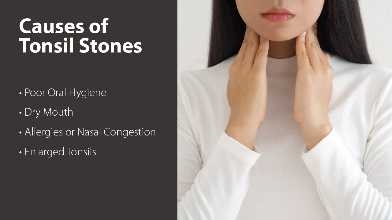What Causes Tonsil Stones?