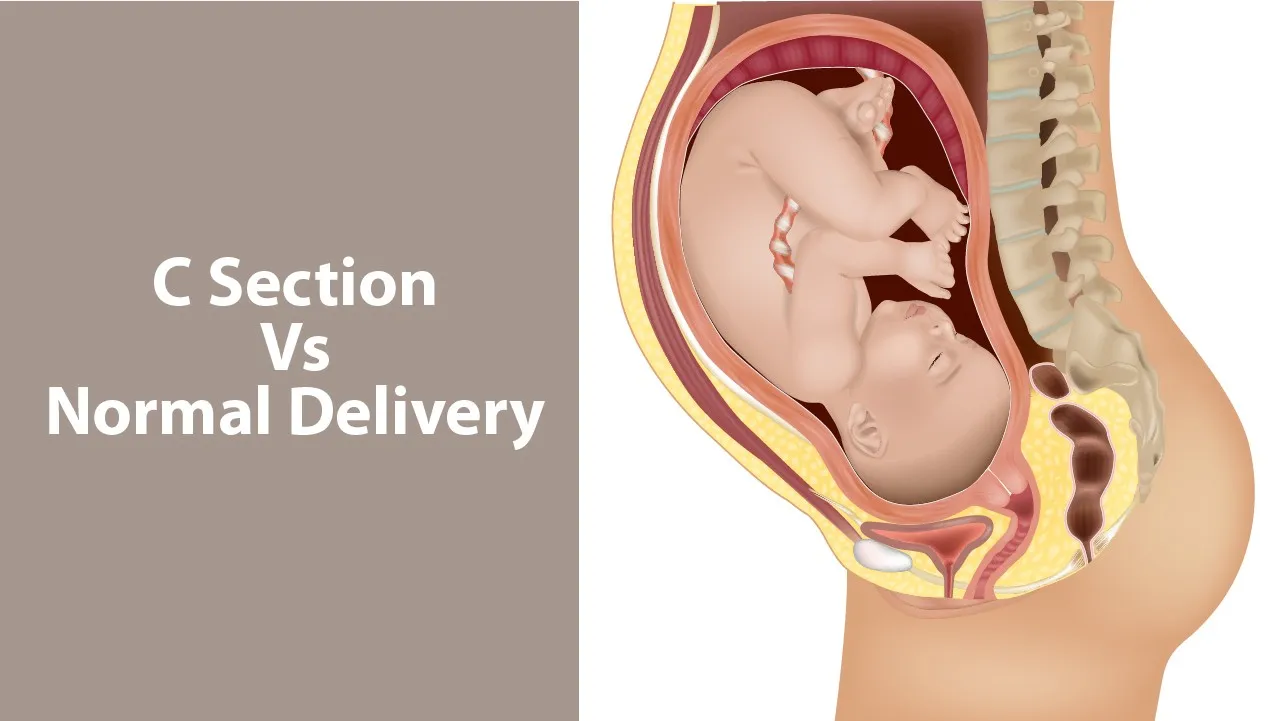 C Section Vs Normal Delivery