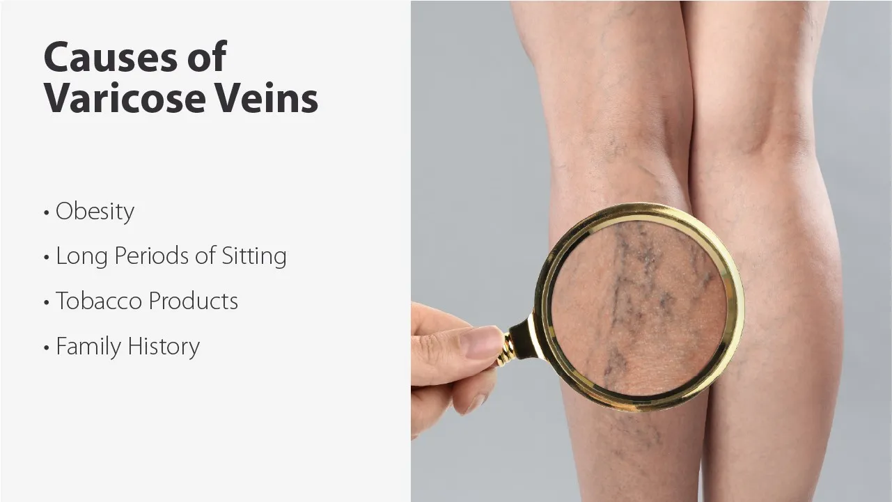 What Causes Varicose Veins?